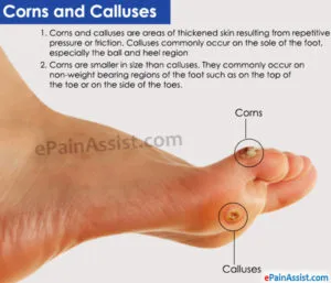 Corns and Calluses.